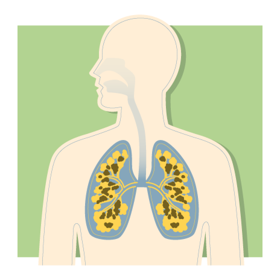 COPD